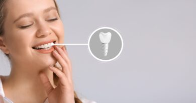 dental implants